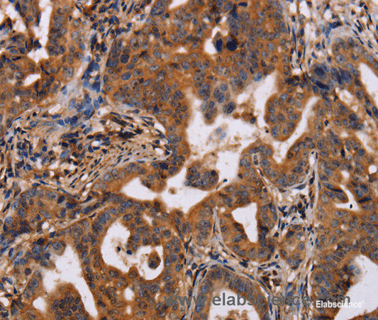 Immunohistochemistry of paraffin-embedded Human gasrtic cancer tissue using IL12RB2 Polyclonal Antibody at dilution 1:40