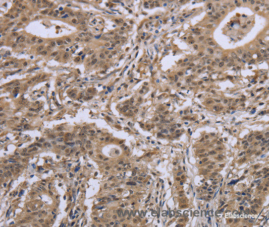 Immunohistochemistry of paraffin-embedded Human gasrtic cancer tissue using IPO8 Polyclonal Antibody at dilution 1:50