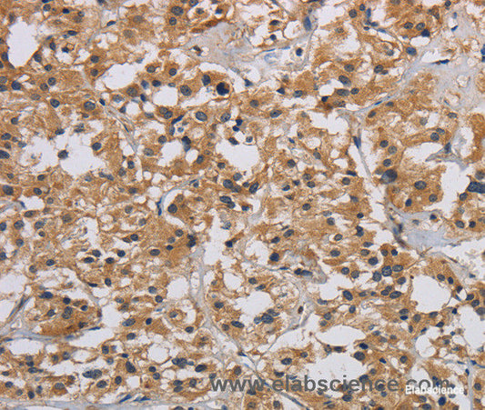 Immunohistochemistry of paraffin-embedded Human thyroid cancer tissue using INPPL1 Polyclonal Antibody at dilution 1:40