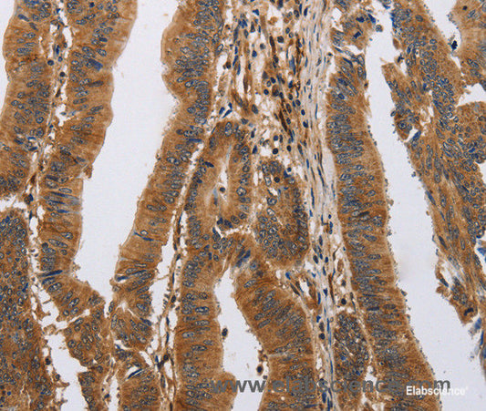 Immunohistochemistry of paraffin-embedded Human colon cancer tissue using ITPR1 Polyclonal Antibody at dilution 1:40