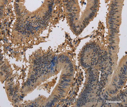 Immunohistochemistry of paraffin-embedded Human colon cancer tissue using KCNA7 Polyclonal Antibody at dilution 1:40