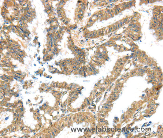 Immunohistochemistry of paraffin-embedded Human colon cancer tissue using KCNG3 Polyclonal Antibody at dilution 1:40