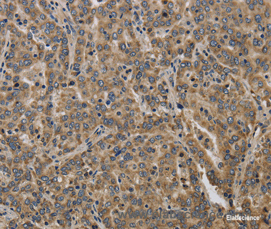 Immunohistochemistry of paraffin-embedded Human liver cancer tissue using KCNMB2 Polyclonal Antibody at dilution 1:40