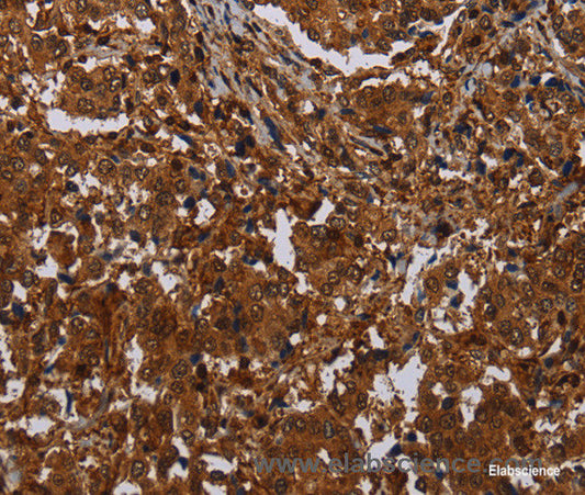 Immunohistochemistry of paraffin-embedded Human liver cancer tissue using MAGEB18 Polyclonal Antibody at dilution 1:30