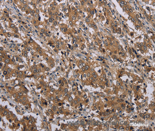 Immunohistochemistry of paraffin-embedded Human liver cancer tissue using MAL Polyclonal Antibody at dilution 1:30