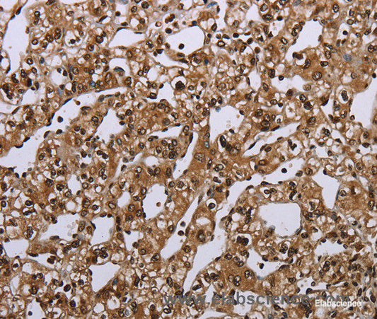 Immunohistochemistry of paraffin-embedded Human prostate cancer tissue using MEIS1 Polyclonal Antibody at dilution 1:40