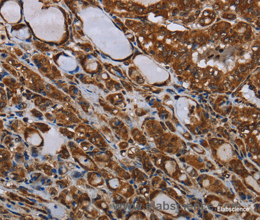 Immunohistochemistry of paraffin-embedded Human thyroid cancer tissue using MT-ND1 Polyclonal Antibody at dilution 1:30