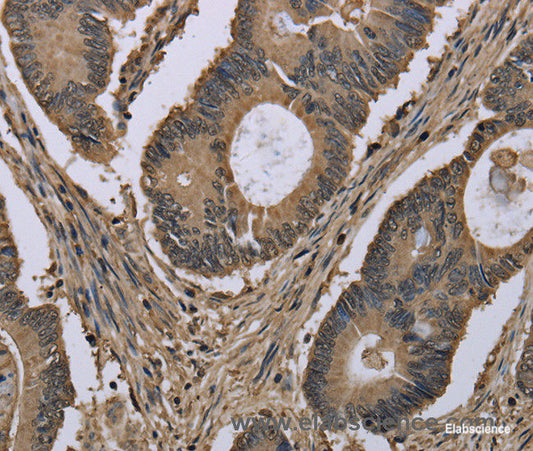 Immunohistochemistry of paraffin-embedded Human colon cancer tissue using MYO18B Polyclonal Antibody at dilution 1:50
