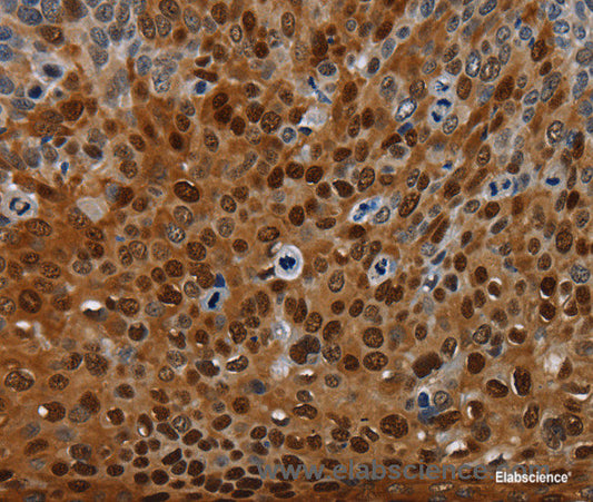 Immunohistochemistry of paraffin-embedded Human cervical cancer tissue using NRP2 Polyclonal Antibody at dilution 1:35