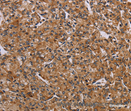 Immunohistochemistry of paraffin-embedded Human prostate cancer tissue using AATK Polyclonal Antibody at dilution 1:45
