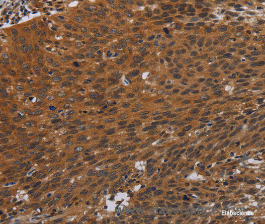 Immunohistochemistry of paraffin-embedded Human cervical cancer tissue using PNOC Polyclonal Antibody at dilution 1:40