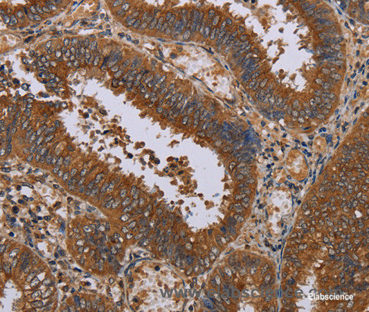 Immunohistochemistry of paraffin-embedded Human colon cancer tissue using NPTX1 Polyclonal Antibody at dilution 1:50