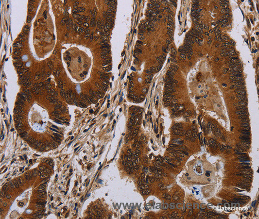 Immunohistochemistry of paraffin-embedded Human colon cancer tissue using DCAF6 Polyclonal Antibody at dilution 1:50