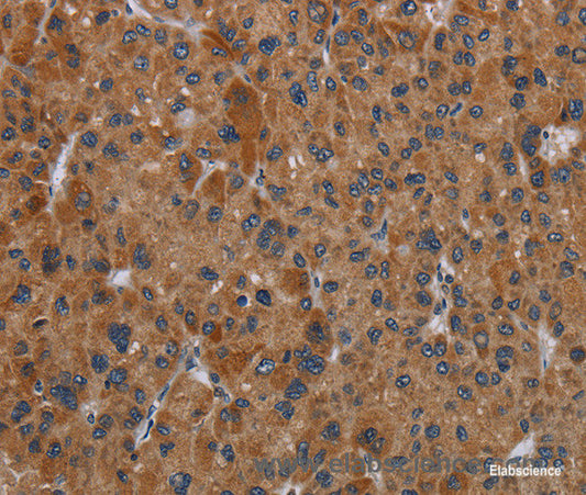 Immunohistochemistry of paraffin-embedded Human liver cancer tissue using OMG Polyclonal Antibody at dilution 1:30