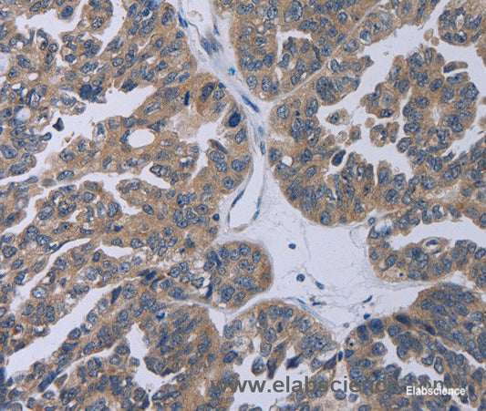 Immunohistochemistry of paraffin-embedded Human ovarian cancer tissue using TP53AIP1 Polyclonal Antibody at dilution 1:50