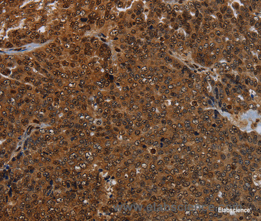 Immunohistochemistry of paraffin-embedded Human ovarian cancer tissue using KDM4B Polyclonal Antibody at dilution 1:50