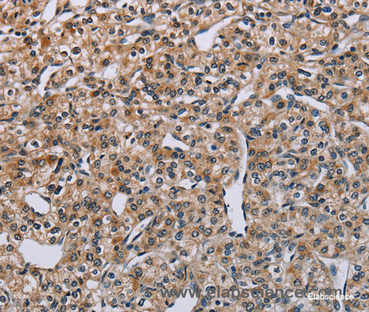 Immunohistochemistry of paraffin-embedded Human prostate cancer tissue using PNPT1 Polyclonal Antibody at dilution 1:40