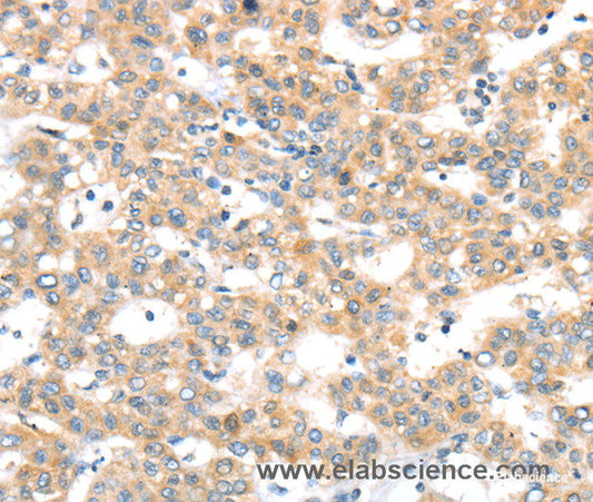 Immunohistochemistry of paraffin-embedded Human breast cancer tissue using RAB24 Polyclonal Antibody at dilution 1:45