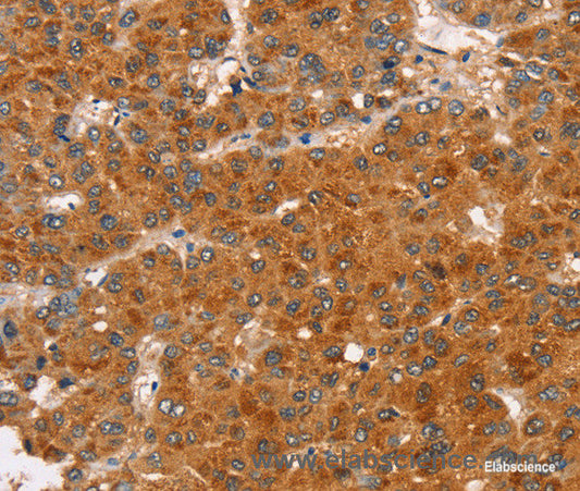Immunohistochemistry of paraffin-embedded Human liver cancer tissue using RASA3 Polyclonal Antibody at dilution 1:35
