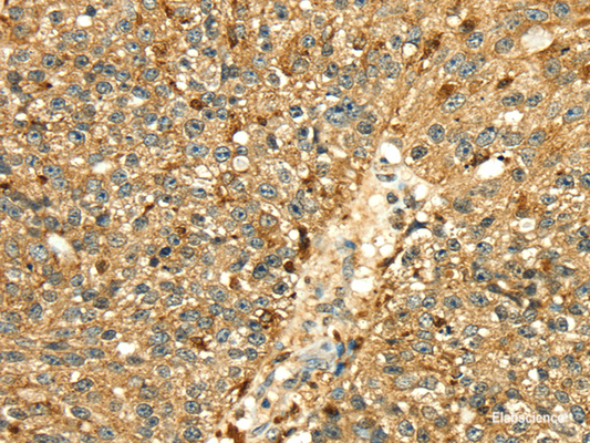 Immunohistochemistry of paraffin-embedded Human breast cancer tissue using Cathepsin H Polyclonal Antibody at dilution 1:50