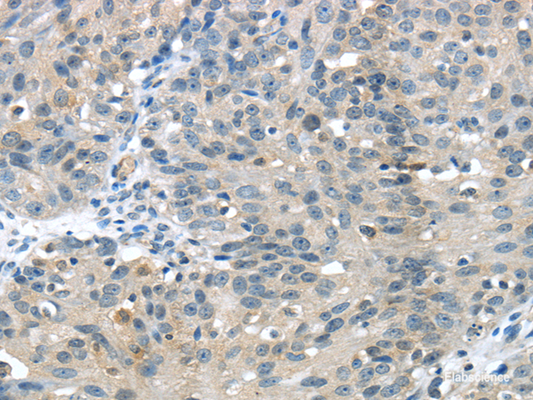 Immunohistochemistry of paraffin-embedded Human breast cancer using GLP2R Polyclonal Antibody at dilution of  1/30