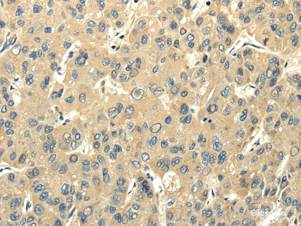 Immunohistochemistry of paraffin-embedded Human liver cancer using PMP2 Polyclonal Antibody at dilution of  1/25