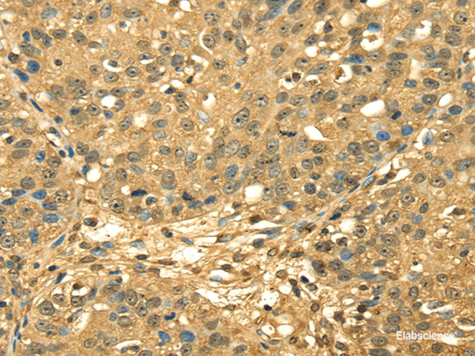 Immunohistochemistry of paraffin-embedded Human breast cancer using RPA2 Polyclonal Antibody at dilution of  1/45