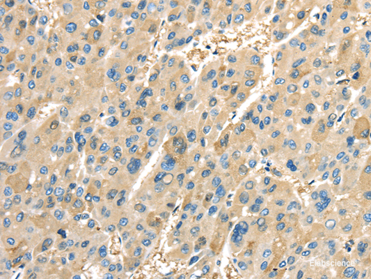 Immunohistochemistry of paraffin-embedded Human liver cancer tissue using COX2 Polyclonal Antibody at dilution 1:40
