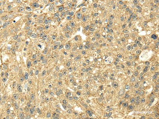 Immunohistochemistry of paraffin-embedded Human breast cancer using SDHA Polyclonal Antibody at dilution of  1/40