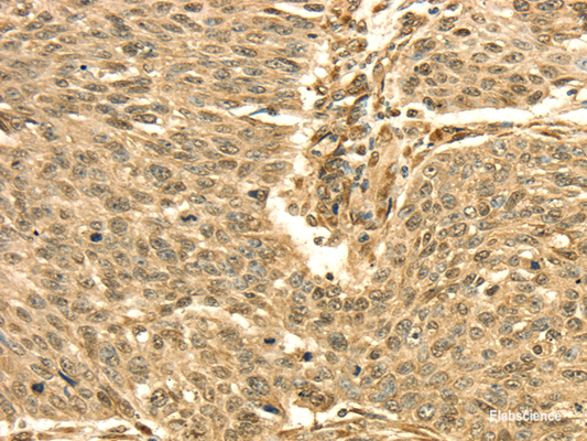 Immunohistochemistry of paraffin-embedded Human lung cancer using SEPT2 Polyclonal Antibody at dilution of  1/30