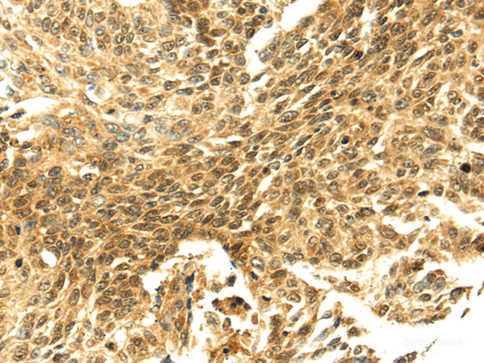 Immunohistochemistry of paraffin-embedded Human lung cancer tissue using SHPRH Polyclonal Antibody at dilution 1:40