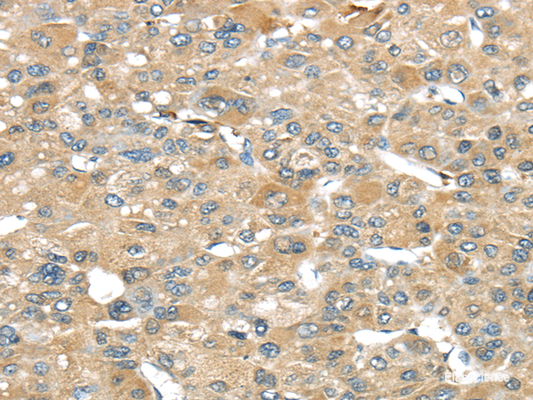 Immunohistochemistry of paraffin-embedded Human liver cancer tissue using SRP54 Polyclonal Antibody at dilution 1:45