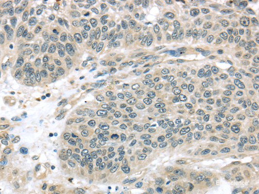 Immunohistochemistry of paraffin-embedded Human lung cancer using THAP4 Polyclonal Antibody at dilution of  1/30
