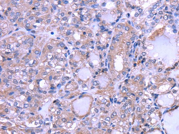 Immunohistochemistry of paraffin-embedded Human thyroid cancer using THRSP Polyclonal Antibody at dilution of  1/30