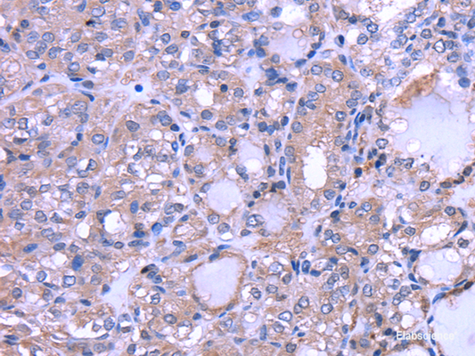 Immunohistochemistry of paraffin-embedded Human thyroid cancer using THRSP Polyclonal Antibody at dilution of  1/30