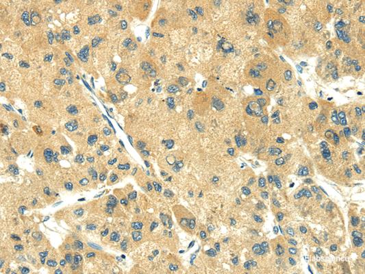 Immunohistochemistry of paraffin-embedded Human liver cancer using TRIM10 Polyclonal Antibody at dilution of  1/35