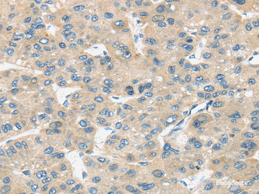 Immunohistochemistry of paraffin-embedded Human liver cancer tissue using TIRAP Polyclonal Antibody at dilution 1:30
