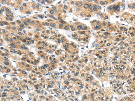 Immunohistochemistry of paraffin-embedded Human liver cancer tissue using TKTL1 Polyclonal Antibody at dilution 1:40