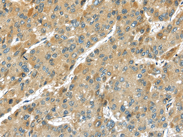 Immunohistochemistry of paraffin-embedded Human liver cancer using TMPRSS11D Polyclonal Antibody at dilution of  1/35