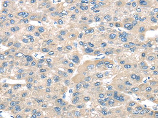 Immunohistochemistry of paraffin-embedded Human liver cancer tissue using TNFAIP8 Polyclonal Antibody at dilution 1:35
