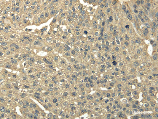Immunohistochemistry of paraffin-embedded Human breast cancer using TRIB2 Polyclonal Antibody at dilution of  1/30