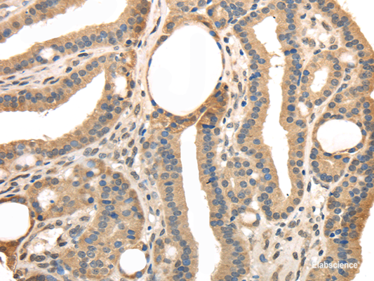 Immunohistochemistry of paraffin-embedded Human thyroid cancer tissue using TRIB3 Polyclonal Antibody at dilution 1:40