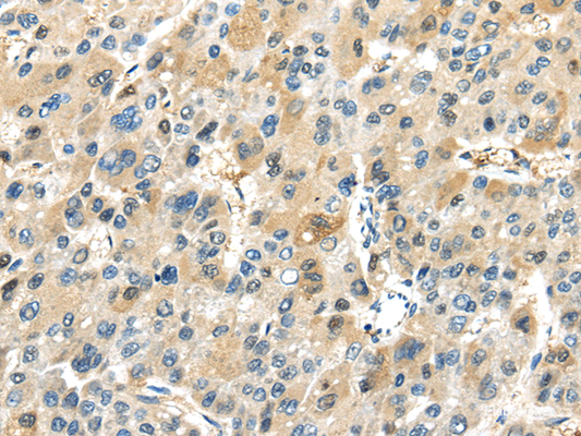Immunohistochemistry of paraffin-embedded Human liver cancer tissue using TRAIP Polyclonal Antibody at dilution 1:40