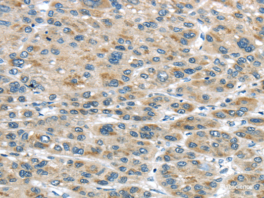 Immunohistochemistry of paraffin-embedded Human liver cancer tissue using TRAIP Polyclonal Antibody at dilution 1:40