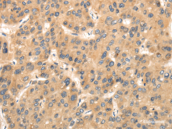 Immunohistochemistry of paraffin-embedded Human liver cancer using TTC23 Polyclonal Antibody at dilution of  1/35