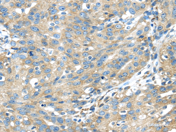Immunohistochemistry of paraffin-embedded Human breast cancer using TXNDC5 Polyclonal Antibody at dilution of  1/40