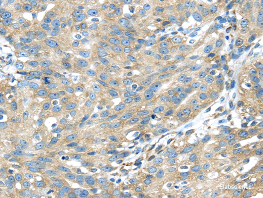 Immunohistochemistry of paraffin-embedded Human breast cancer using TXNDC5 Polyclonal Antibody at dilution of  1/40