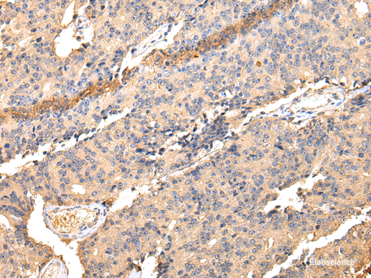 Immunohistochemistry of paraffin-embedded Human prostate cancer using SDCBP Polyclonal Antibody at dilution of  1/40