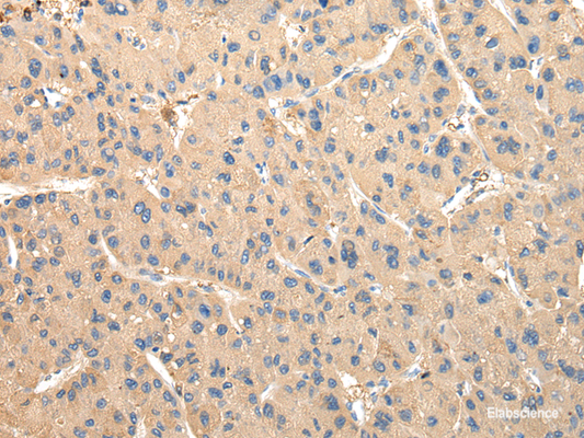 Immunohistochemistry of paraffin-embedded Human liver cancer tissue using DUSP11 Polyclonal Antibody at dilution 1:50