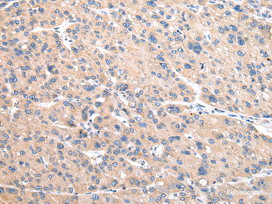 Immunohistochemistry of paraffin-embedded Human liver cancer using VAMP4 Polyclonal Antibody at dilution of  1/30